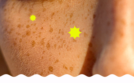 PIGMENTATION SPOTS