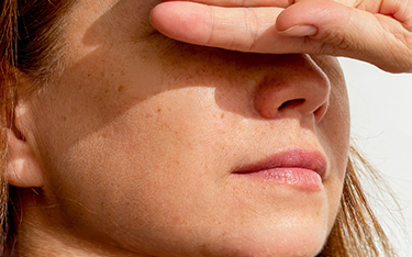 BLACKHEADS & PORE ISSUES