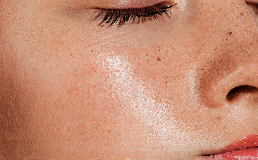 OILY, SHINY SKIN