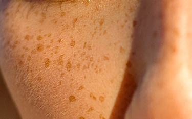 PIGMENTATION SPOTS