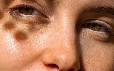 DRY, DEHYDRATED, AND LIPID-DEFICIENT SKIN