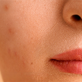 Breakouts