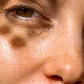 Dry dehydrated and lipid-deficient skin