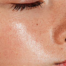 Oily, shiny skin