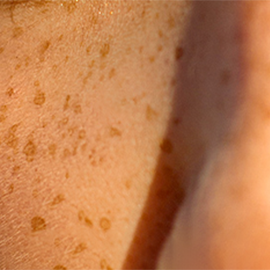 Pigmentation spots