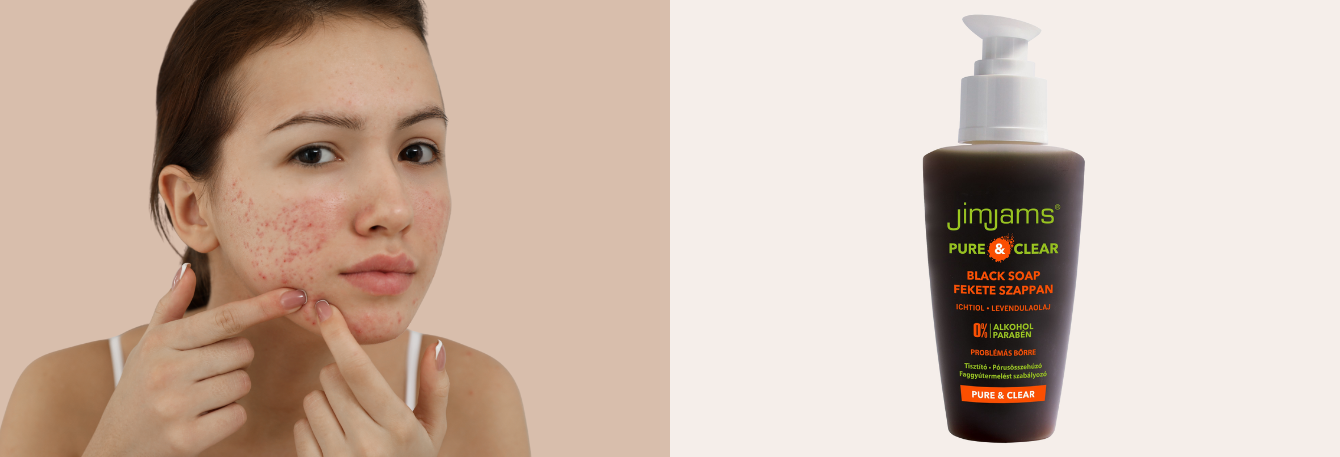 Clear skin with JimJams CLEAN and MATT Black Soap