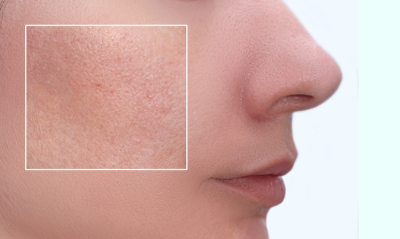 Taking care of oily skin